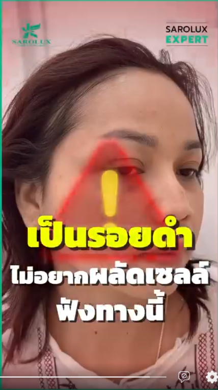 เป็นรอยดำไม่อยากผลัดเซลล์ฟังทางนี้