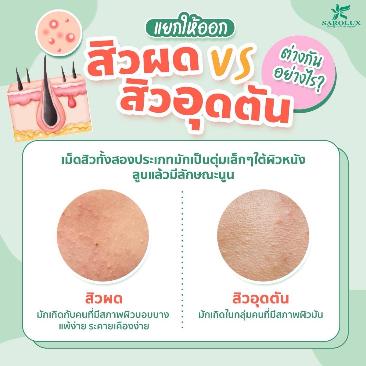 สิวผด VS สิวอุดตัน ต่างกันอย่างไร