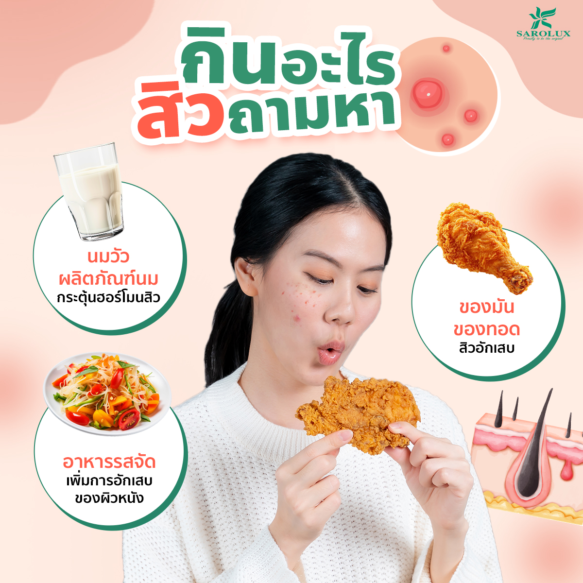 กินอะไรสิวถามหา