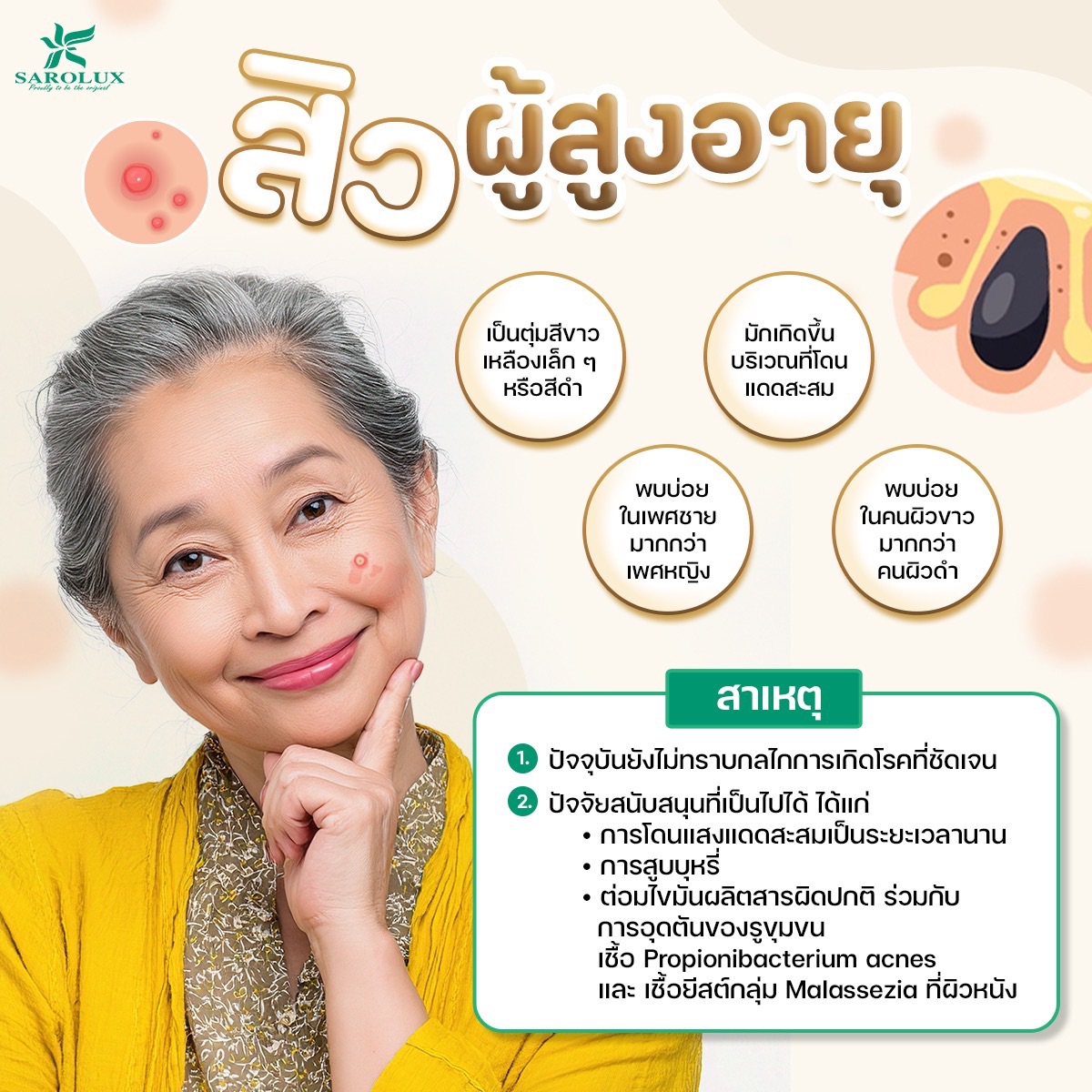 สิวผู้สูงอายุ สิวผู้สูงอายุ