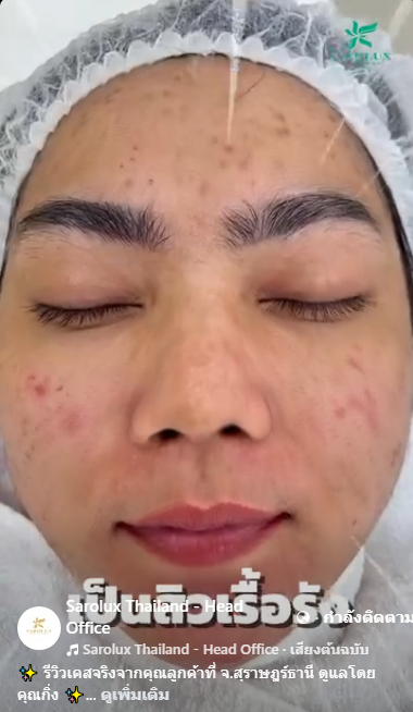 รีวิวลูกค้าเป็นสิวเรื้อรัง ที่ศ๔ูนย์ฯ จ.สุราษฎร์ธานี ดูแลโดยคุณกิ่ง