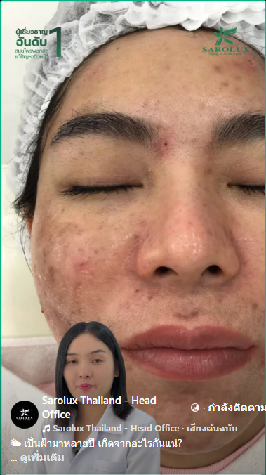 เป็นฝ้ามาหลายปีเกิดจากอะไร เป็นฝ้ามาหลายปีเกิดจากอะไร