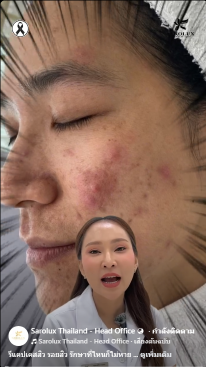 รีวิวลูกค้าเป็นสิวเรื้อรัง