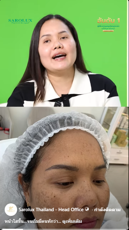 ประสบการณ์ได้เล่ามาแก้ไขปัญหาสิวฝ้าที่ศูนย์สะโรรักษ์