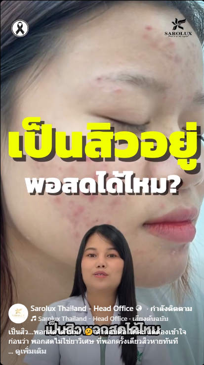 เป็นสิวอยู่พอกสดได้ไหม?