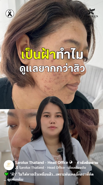 เป็นฝ้าทำไมดูแลยากกว่าสิว