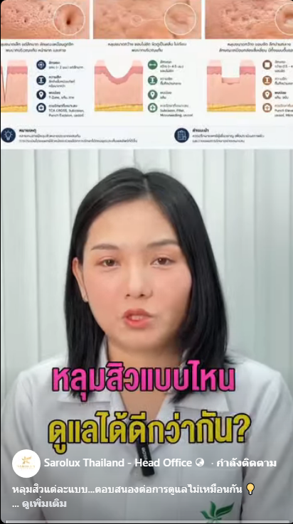 หลุมสิวแบบไหนดูแลได้ดีกว่ากัน