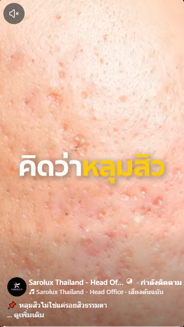หลุมสิวไม่ใช่แค่รอยสิวธรรมดา